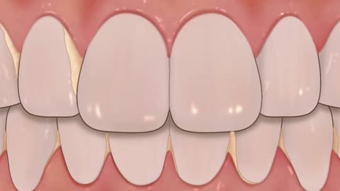 [ASMR] teeth scaling and tartar removal animation