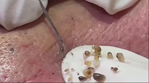 Blackhead Removal On Face