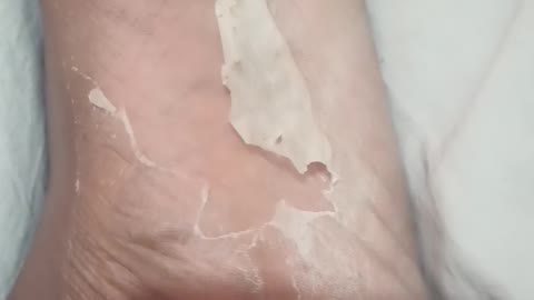 Skin Peeling