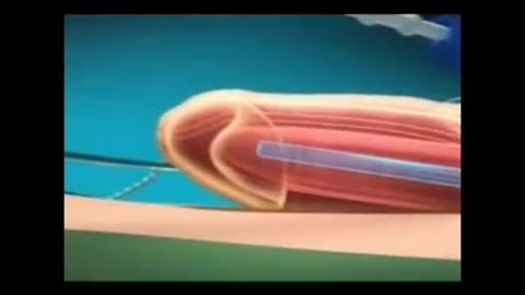 Penile implant surgery