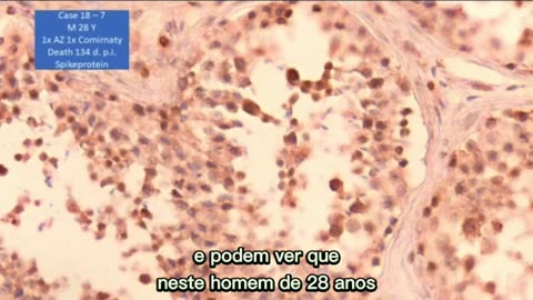 ⚠️😱💉Dr. Arne Burkhardt - A proteína Spike está nos testículos, quase que não tem espermatócitos😱💉⚠️