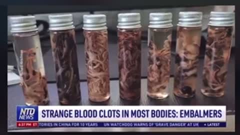 EMBALMERS FINDING MORE STRANGE BLOOD CLOTS