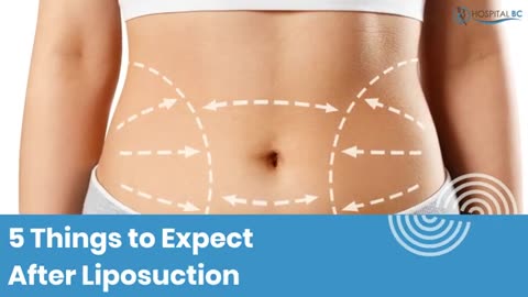 Post-Liposuction Recovery: What to Expect