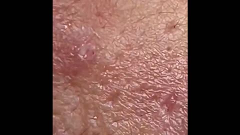 Extraction blackheads