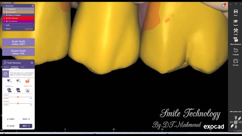 #design #naildesign #dental #dentaldesign #exocadexpert