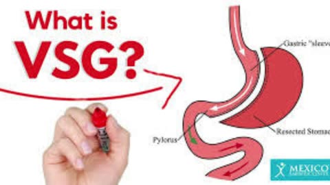 What is vsg surgery?