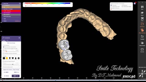 #design #naildesign #dental #dentaldesign #exocadexpert