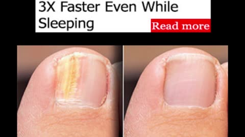 How To Clear Nail Fungus 3X Faster Even While Sleeping?