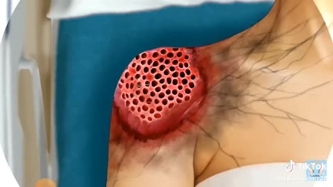 ASMR - Shoulder treatment - Severe injury Animation - Spider attack treatment - Worm removal #asmr