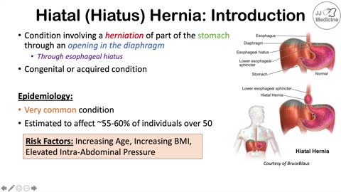 Hiatal (Hiatus) Hernia Signs & Symptoms (& Why They Occur)