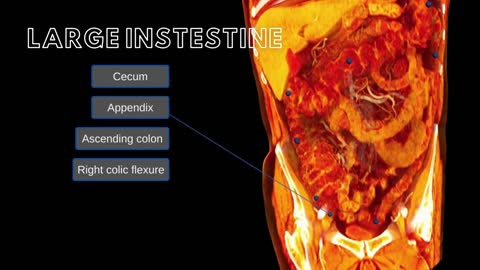 Large Intestine and Umbilical Hernias