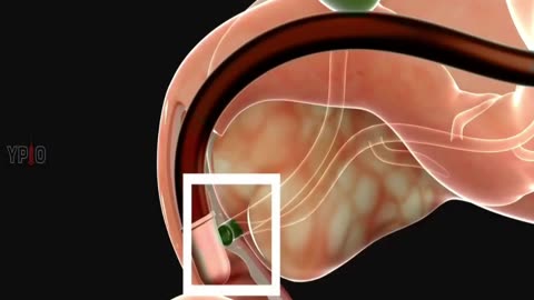 ERCP (endoscopic retrograde cholangiopancreatography) - Procedure 3D Animation