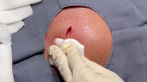 Dr Pimple Popper Opens The 'Gulf Coast' Cyst