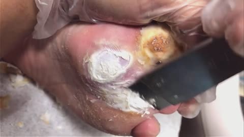 FIVE YEARS OF PLANTAR WARTS