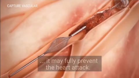 A device that removes large blood clot and prevent or reduce the severity of heart attacks