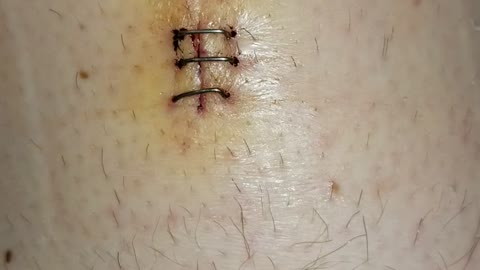 Staples After Surgery