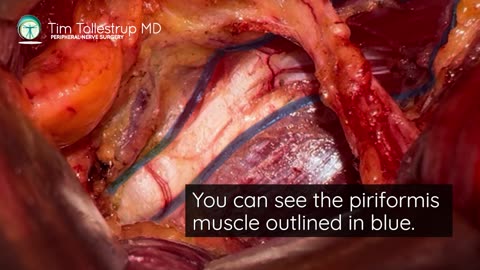 500 Piriformis Syndrome Surgeries