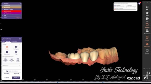 #design #naildesign #dental #dentaldesign #exocadexpert