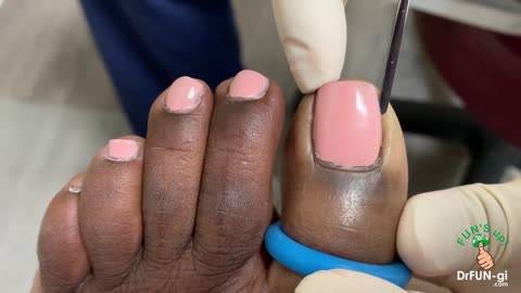 Beautiful DEEP Pink Ingrown Nail Removal!