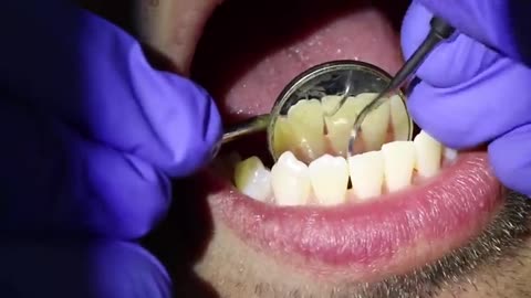 How Teeth Are Cleaned At The Dentist