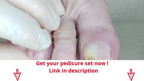 Solved with a number 15 - educational footcare video