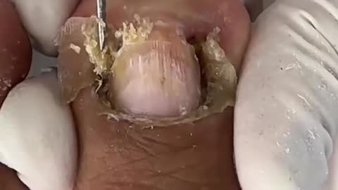 Satisfying video of toe nail