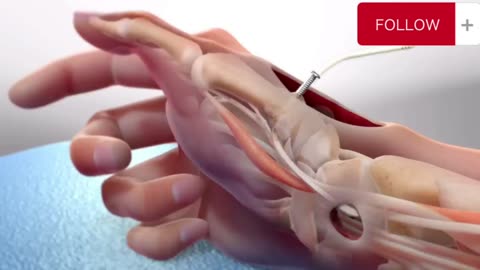 Basal Joint Surgery [ 3D Animation ]