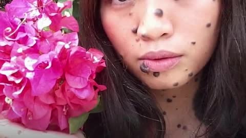 Malaysian girl born with moles covering her body challenges beauty standards