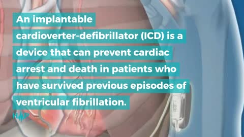 Guide To Treating And Preventing Ventricular Fibrillation