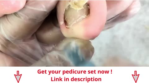 Skill versus nail - Podology educational video