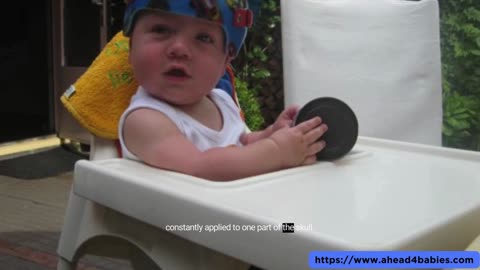 Treatment For Plagiocephaly Head Shaping Helmet