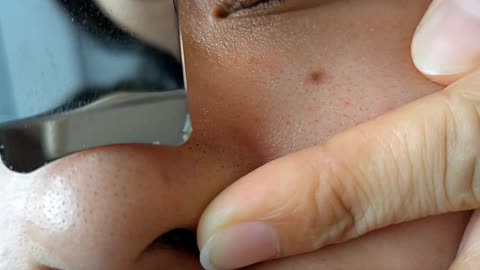 BLACKHEAD