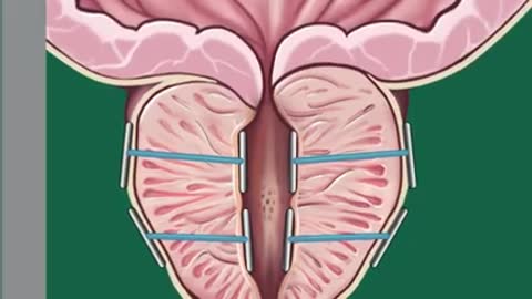 Unusual Prostate Technique Doctor's Are Raving About Leads To Prostate Shrinkage