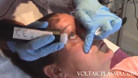 Plasma Lower Eyelid Tightening Training including sound, healing progression, before and afters