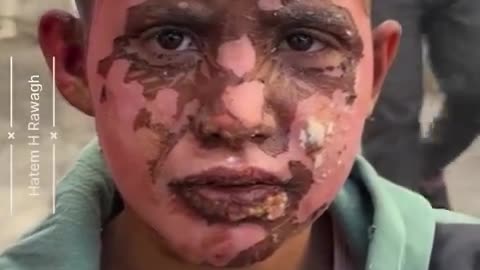 Palestinian mother feeds her son, who bears severe burns