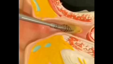 Ear wax removal