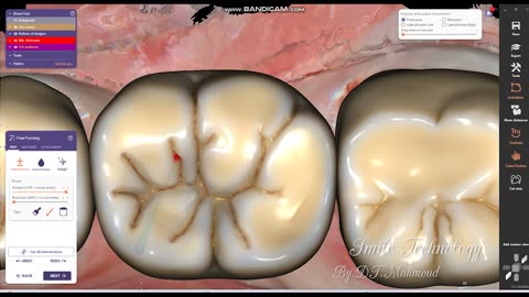 #design #naildesign #dental #dentaldesign #exocadexpert