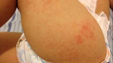 Home Remedies for Baby Rashes, natural & organic