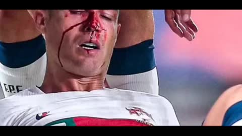 Cristiano ronaldo nose break in live match #cristianoronaldo #ronaldo