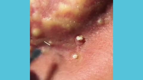 Oddly satisfying behind-the-ear pimple popping