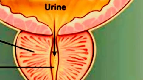 BPH l Seminal V cyst l CA prostate l 1