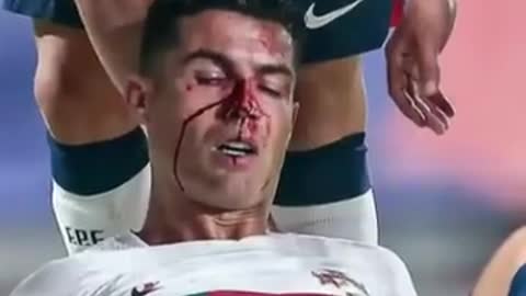 Cristiano Ronaldo bloodied Portugal Match #shorts l Ronaldo Injured Portugal vs Czech Republic #cr7