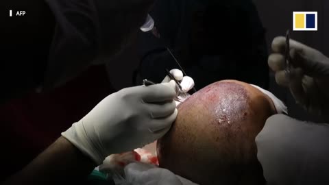 Indian man dies after hair transplant goes fatally wrong