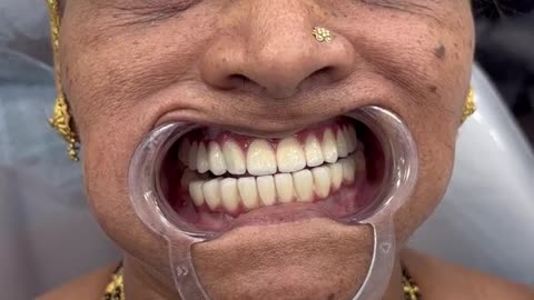 Full Mouth Dental Implants in Navi Mumbai