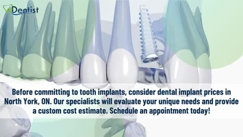 Advantages of Dental Implants