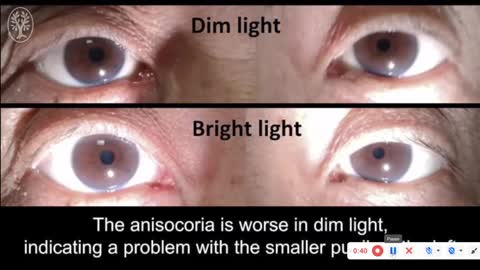 Left sixth cranial nerve palsy with left Horner syndrome localizing to the left cavernous sinus