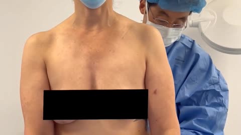 Inside Awake Liposuction Surgery with Dr. Kenneth Kim | Call 213-700-4297