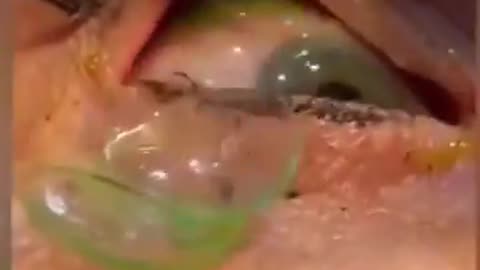 Doctor removes 23 contact lenses stuck in a patient's Eye like a stack of pancakes