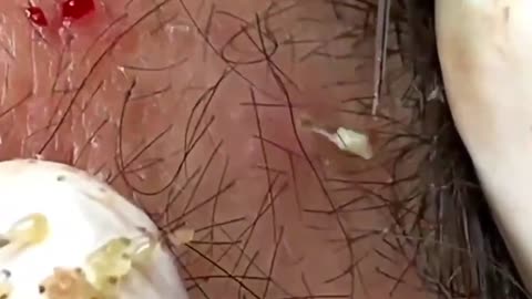 Giants Deep Blackheads, Whiteheads, Big Pimples, Hidden Acne Removal - Best Popping Videos #000012