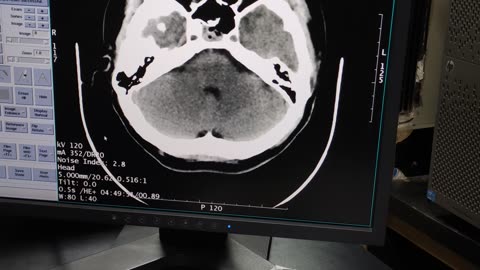 Brain injury due to road accident, CTs scan film #medical